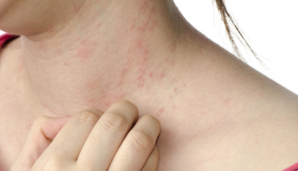 weißer hautkrebs vorstufe