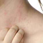 weißer hautkrebs vorstufe